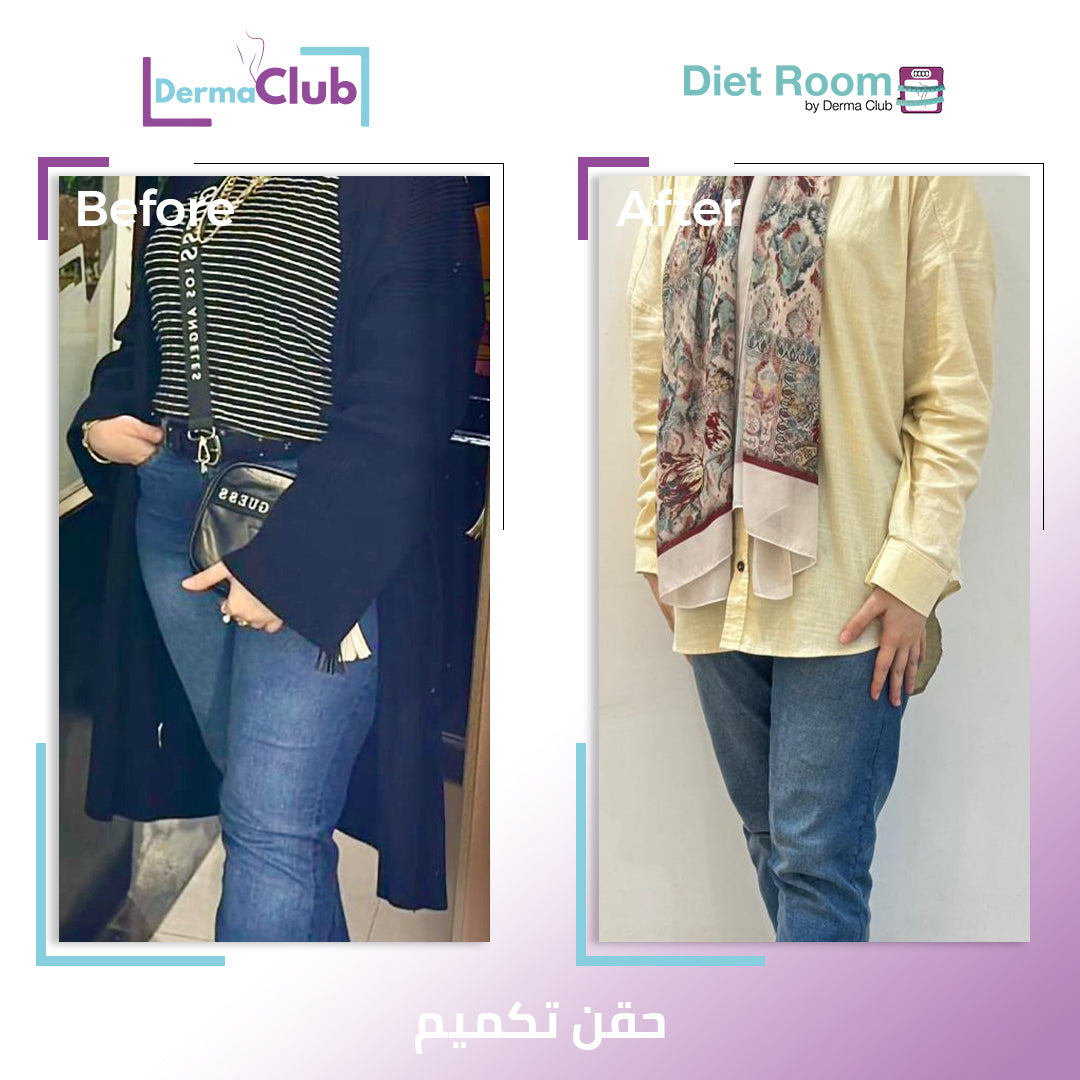 حقن بديل التكميم