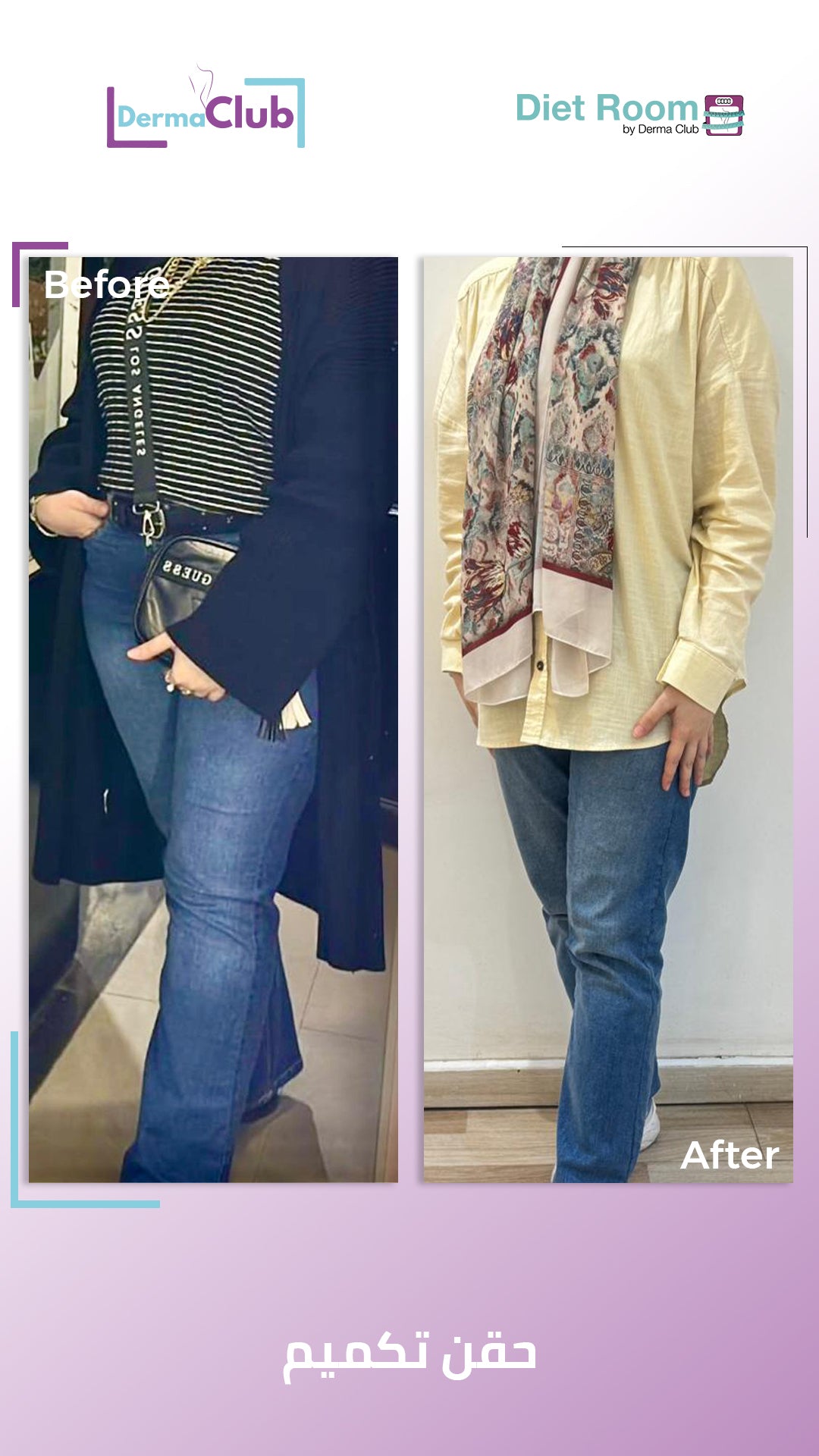 حقن بديل التكميم