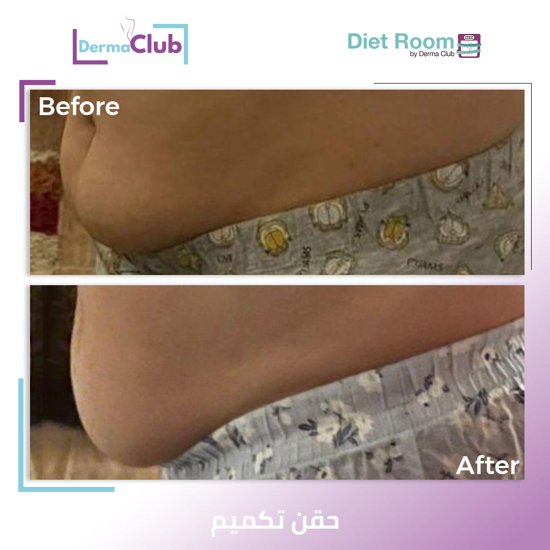 حقن بديل التكميم