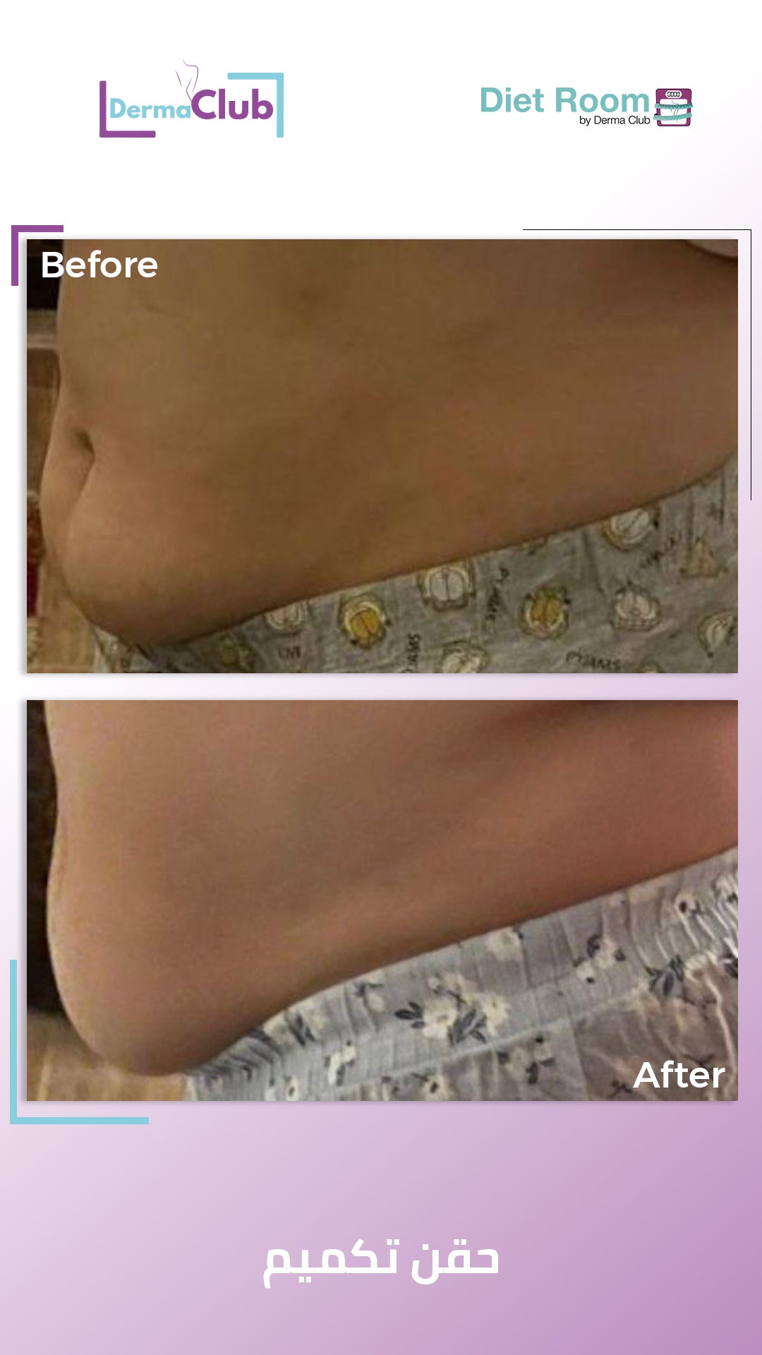 حقن بديل التكميم